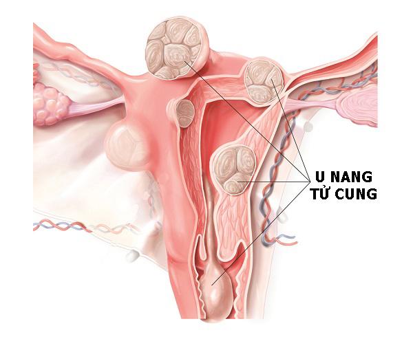u nang co tu cung