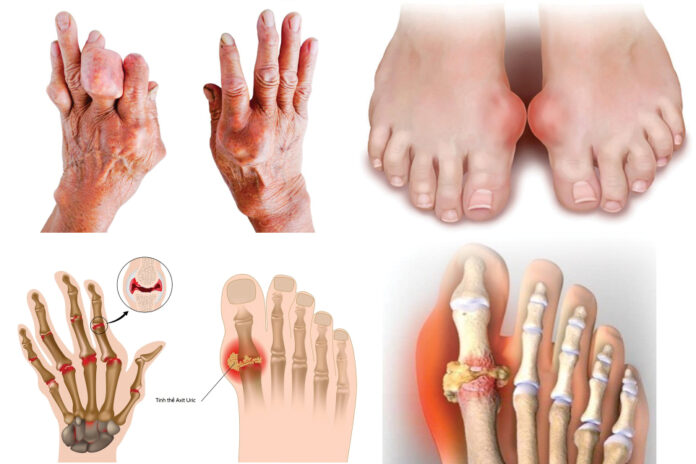 benh gout man tinh